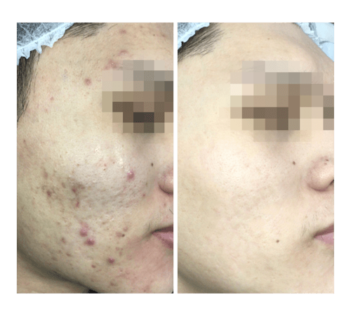 Acne Scars