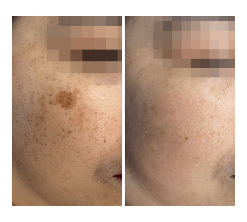 Melasma